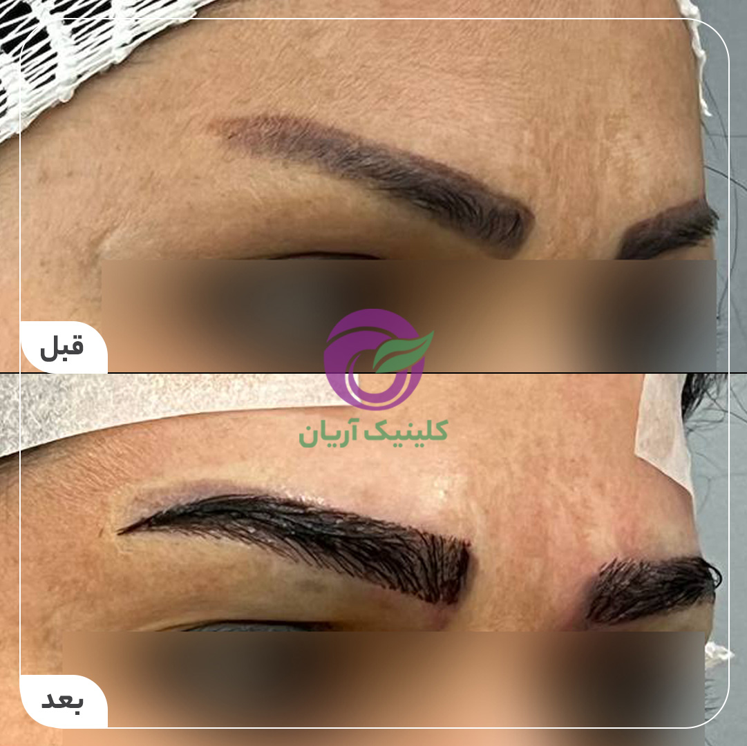 گالری فیلم کاشت ابرو